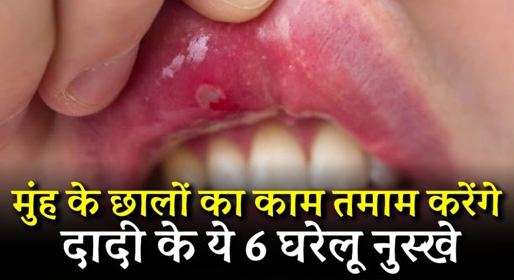 Mouth Ulcer Home Remedies